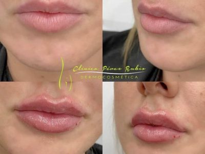 Relleno y aumento de labios